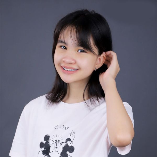 Niềng răng móm có đau nhức gì không?