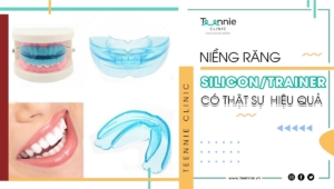 Niềng răng Silicon/Trainer có thực sự hiệu quả như bạn nghĩ?