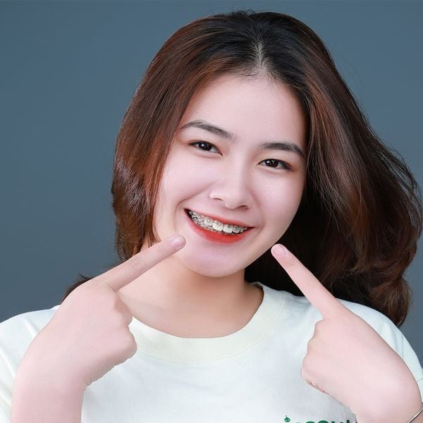 Niềng răng sứ có mang lại hiệu quả?