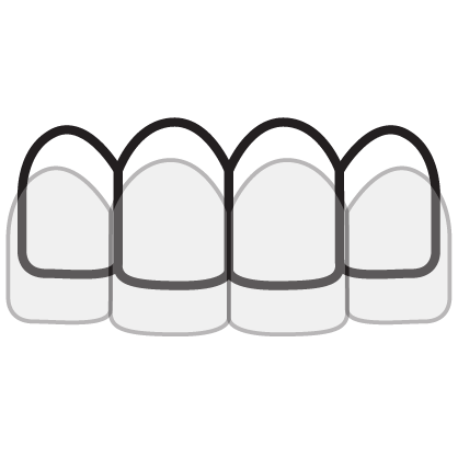 nieng rang trong suot invisalign