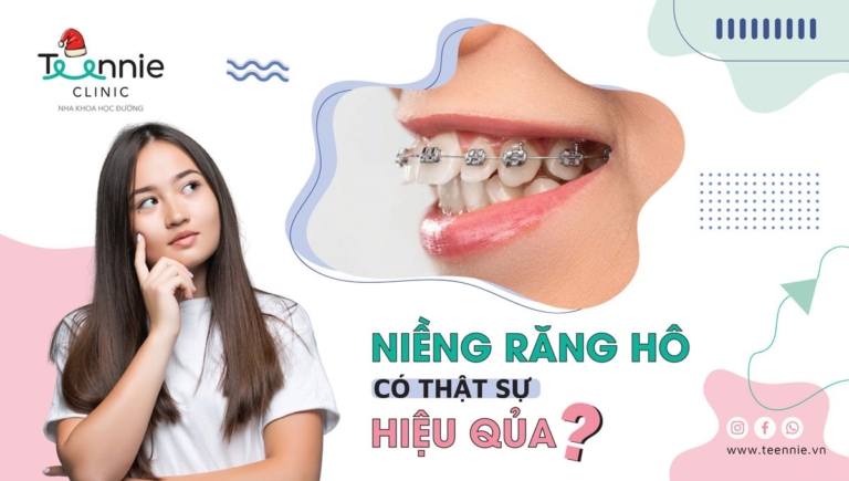 Răng hô nguyên nhân do đâu? Niềng răng hô có thực sự hiệu quả?