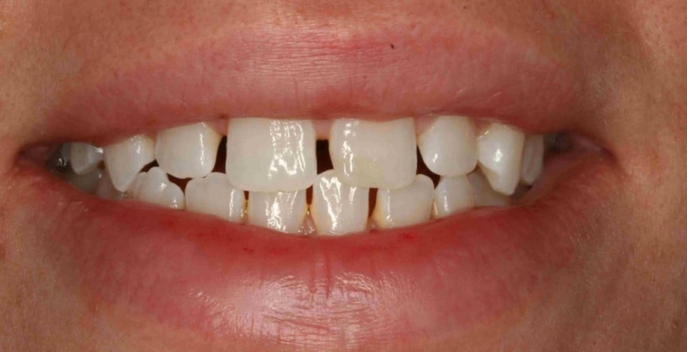 Răng thưa có ảnh hưởng như thế nào đến vận mệnh?