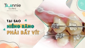 Tại sao niềng răng phải bắt vít? Những ai cần thực hiện?