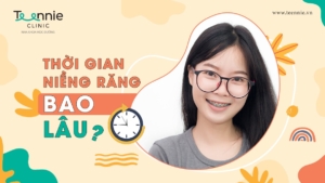 Thời gian niềng răng bao lâu? Tiết lộ những yếu tố quyết định