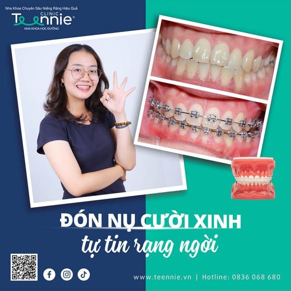 Tiêu chí lựa chọn nha khoa niềng răng phù hợp