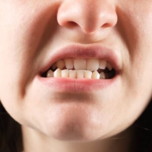 Tình trạng lệch khớp cắn gây hại như thế nào?