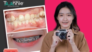 Trẻ em dưới 18 tuổi có nên niềng răng không?