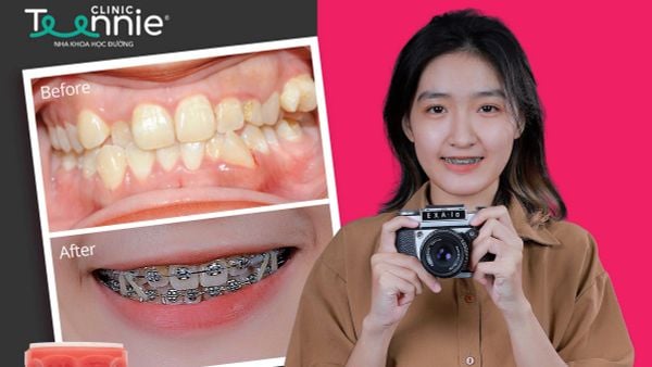 Trẻ em dưới 18 tuổi có nên niềng răng không?