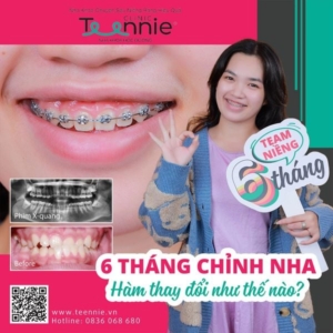 Tự lấy cao răng và những điều cần biết