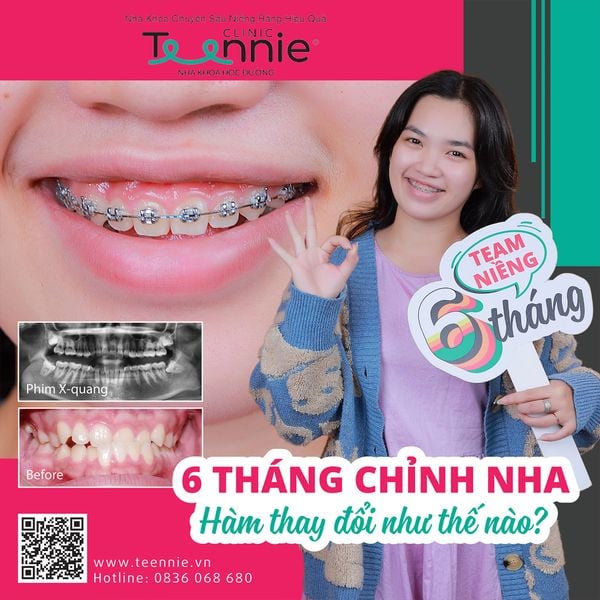 Tự lấy cao răng và những điều cần biết