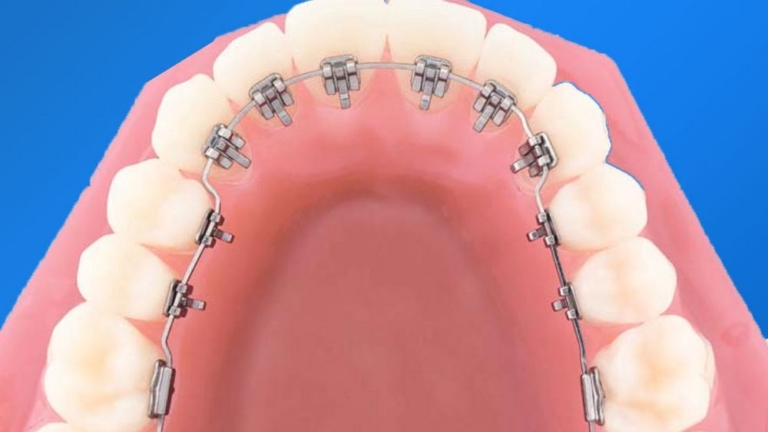 Ưu nhược điểm của việc niềng răng mặt trong?