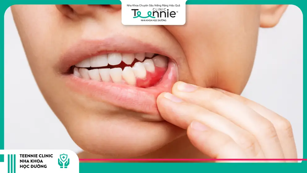 5 dấu hiệu ở răng miệng cảnh báo đường huyết cao