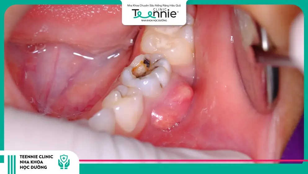 5 dấu hiệu ở răng miệng cảnh báo đường huyết cao