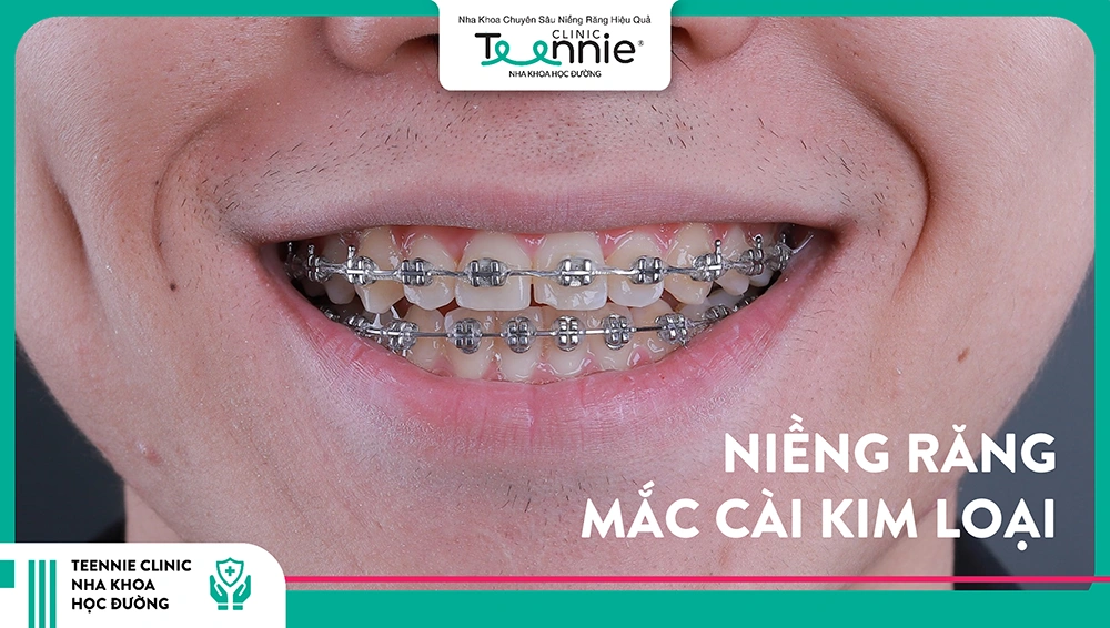 Niềng răng mắc cài kim loại kinh điển