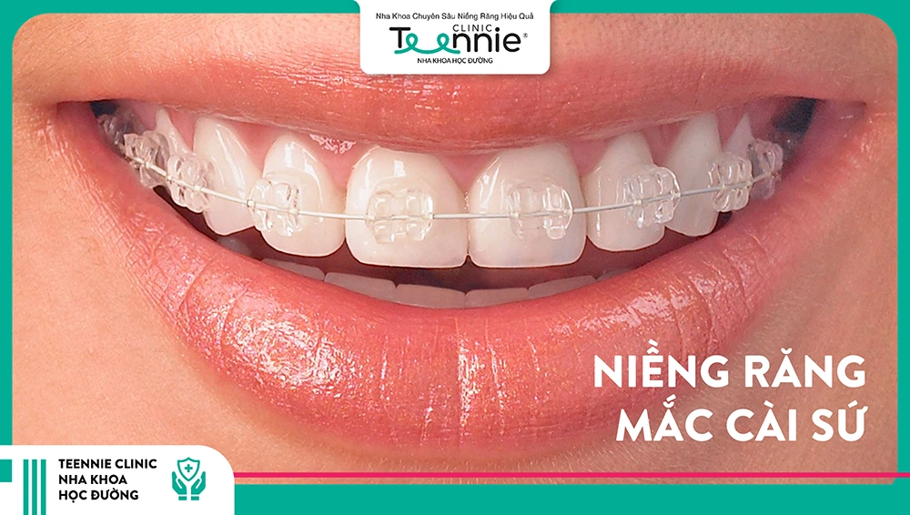Niềng răng mắc cài sứ