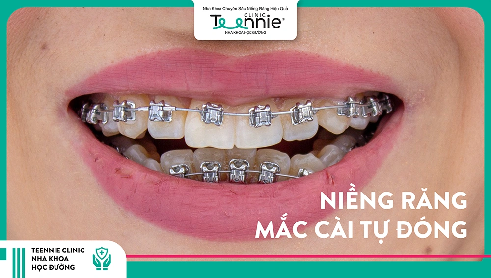 Niềng răng mắc cài tự đóng