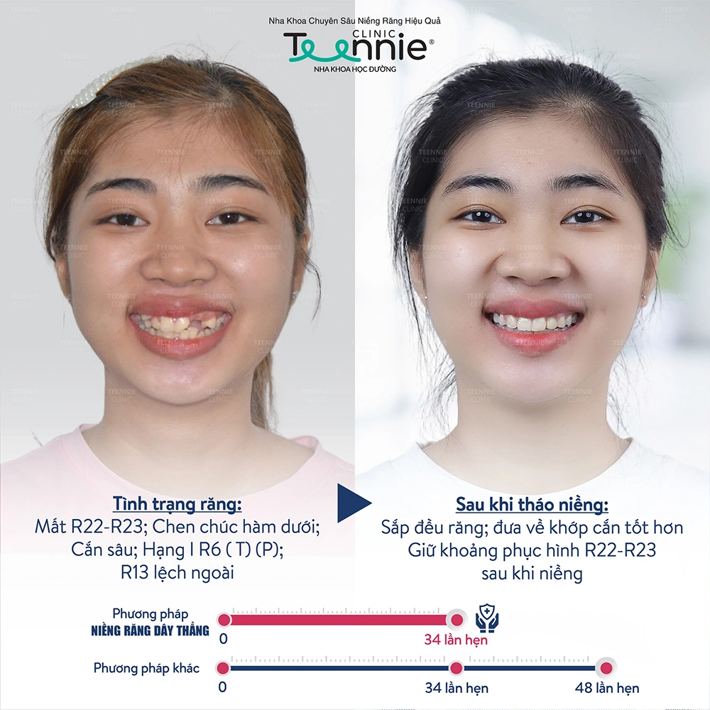 Kết quả của khách hàng niềng răng tại Teennnie