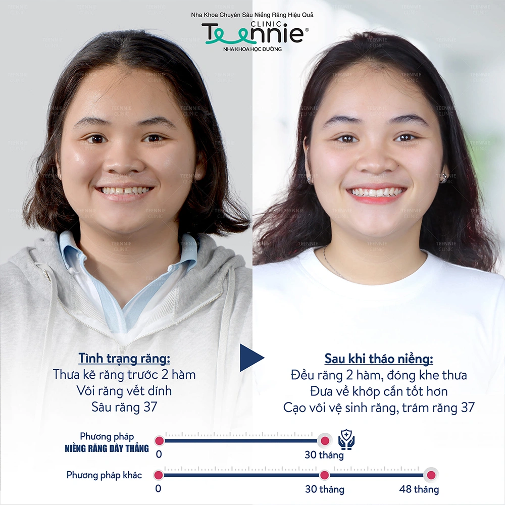 Kết quả của khách hàng niềng răng tại Teennnie