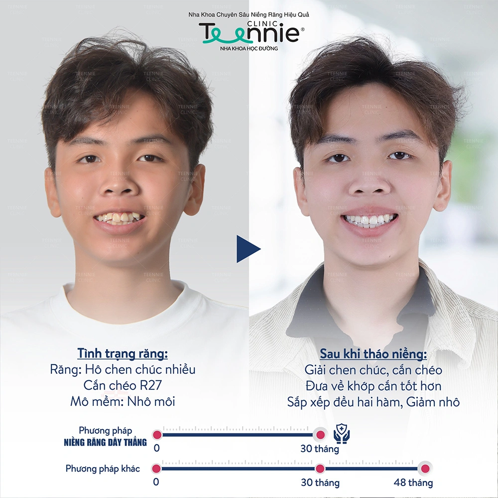 Kết quả của khách hàng niềng răng tại Teennnie