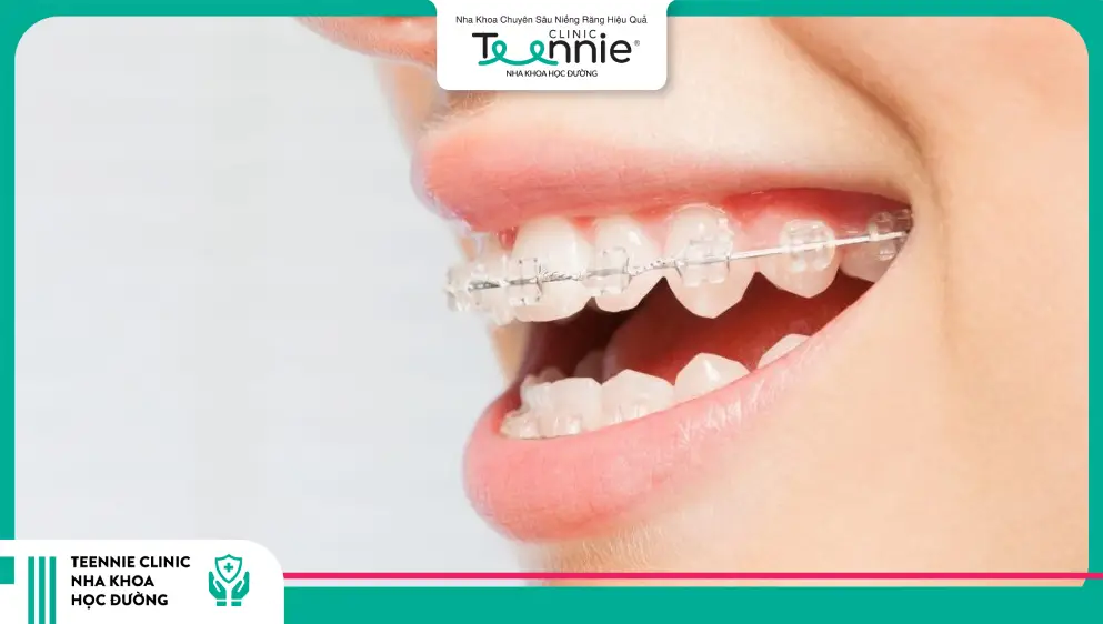 Có nên sử dụng niềng răng mắc cài sứ không?