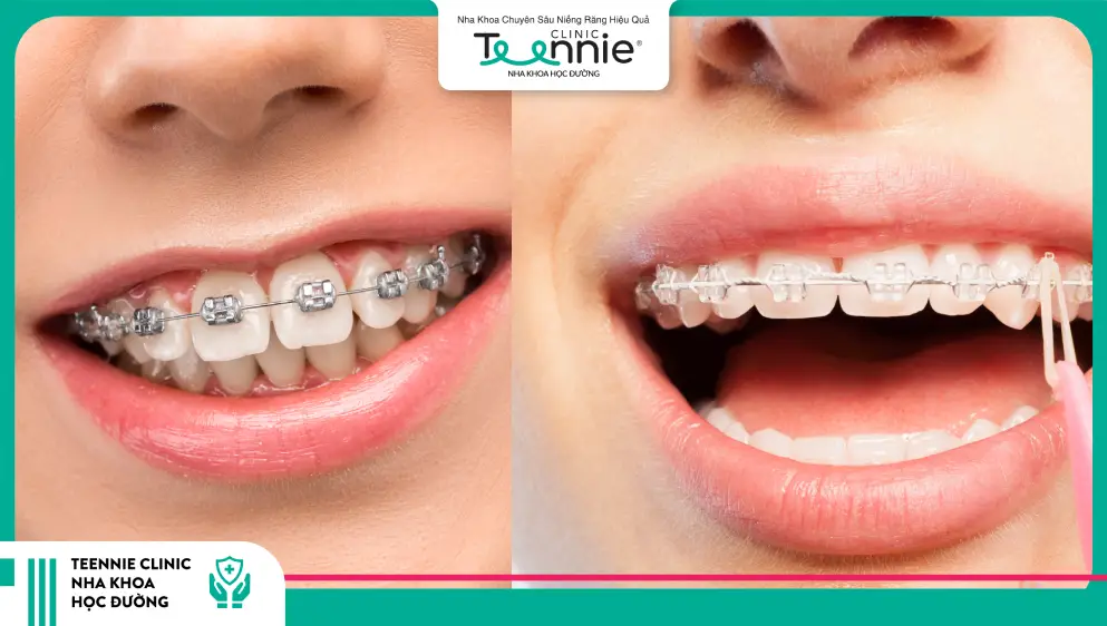 Có nên sử dụng niềng răng mắc cài sứ không?