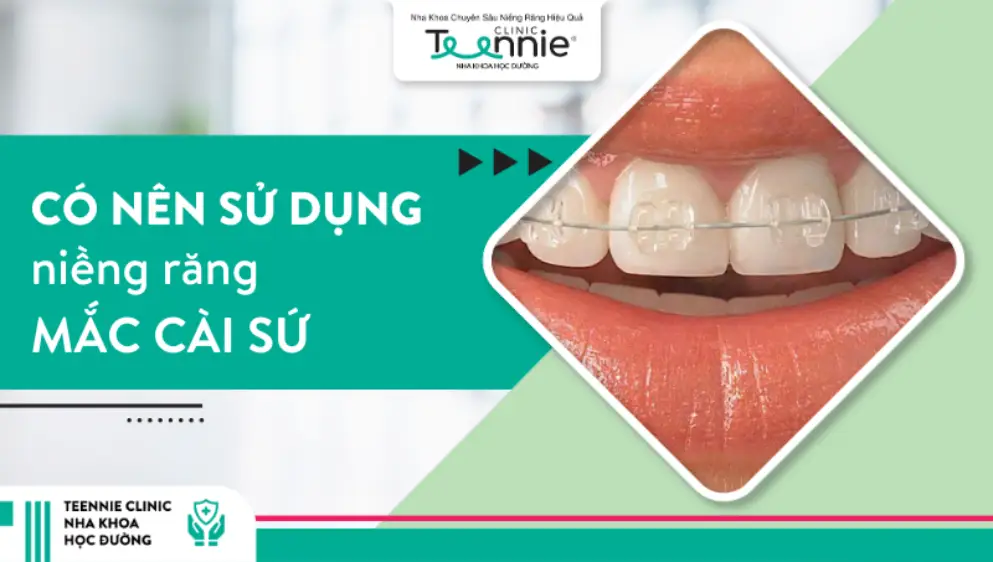 Có nên sử dụng niềng răng mắc cài sứ không?