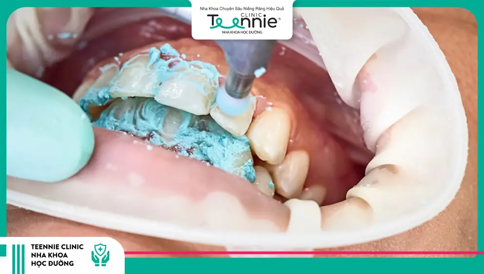 Đánh bóng răng diễn ra như thế nào?