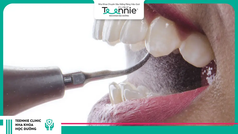 Đánh bóng răng diễn ra như thế nào?