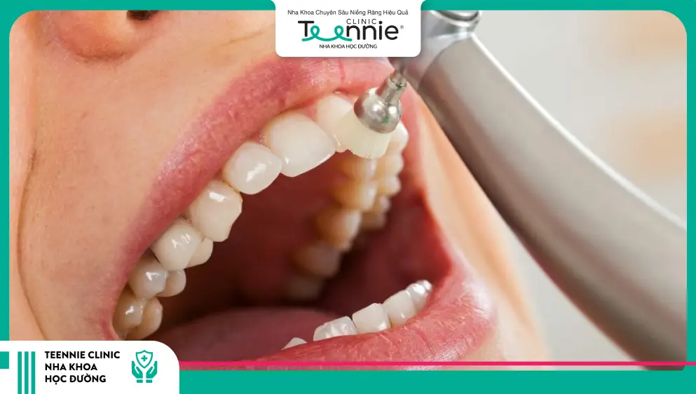 Đánh bóng răng diễn ra như thế nào?