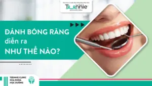 Đánh bóng răng diễn ra như thế nào?