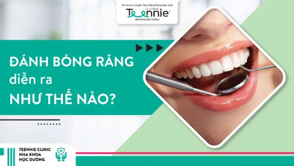 Đánh bóng răng diễn ra như thế nào?
