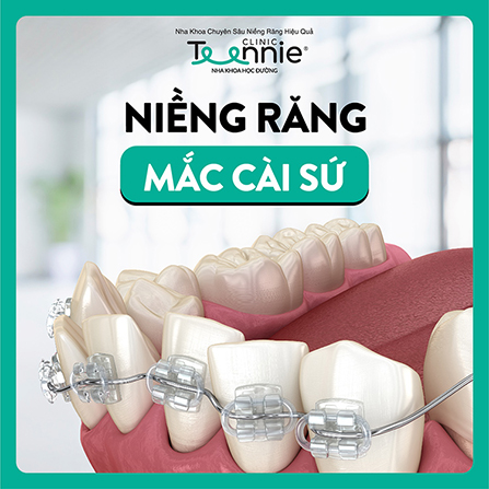 Niềng răng mắc cài sứ