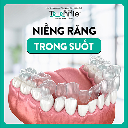 Niềng răng trong suốt