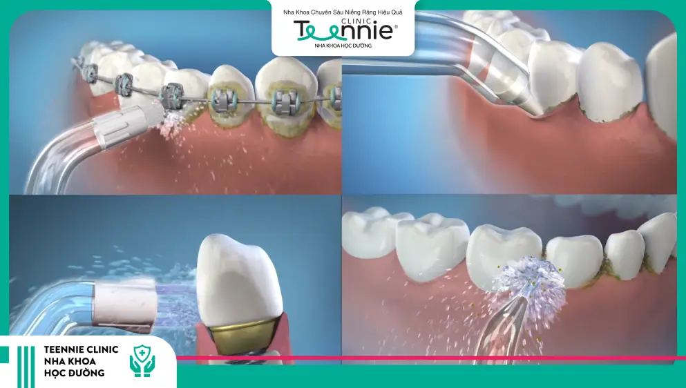 Máy tăm nước phù hợp với người làm răng thẩm mỹ
