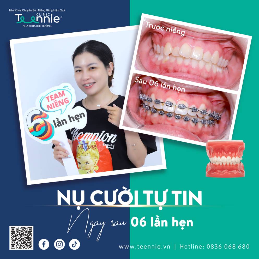 Nhổ răng số 7 có nên hay không?