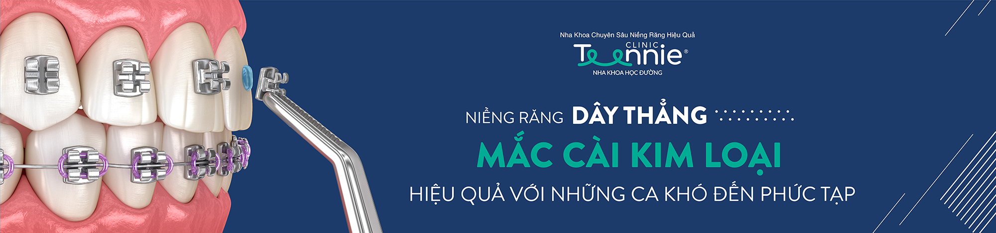 Niềng răng mắc cài kim loại